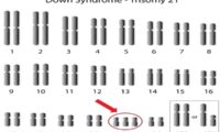 新研究　ダウン症の原因がヒトの老化メカニズムと類似