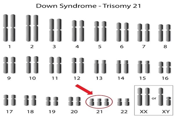 新研究　ダウン症の原因がヒトの老化メカニズムと類似