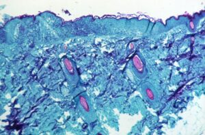 サル痘、性的接触や長時間の「飛沫暴露」で感染　厚労省が注意喚起