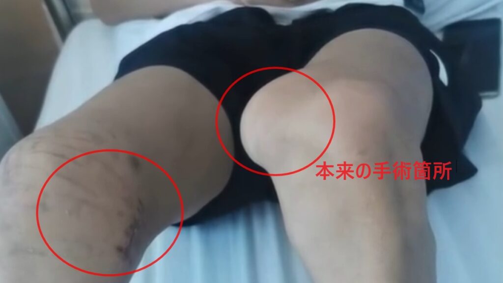 医者が左ヒザの手術で右ヒザを切除 ！　現代中国でトラブルを解決するには