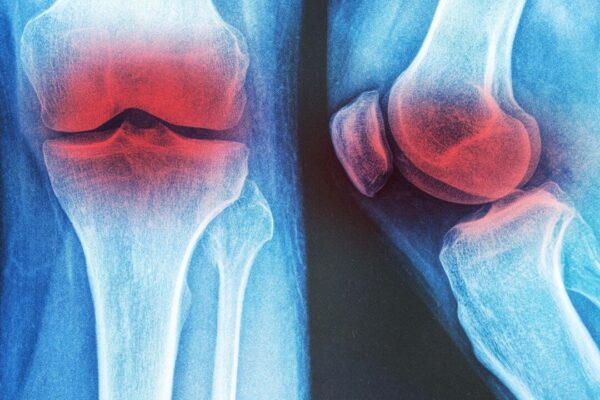 膝の変形性関節症に効く　3つの非薬物療法