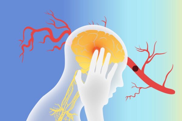 迷走神経刺激療法が脳卒中回復に役立つ可能性——その仕組み